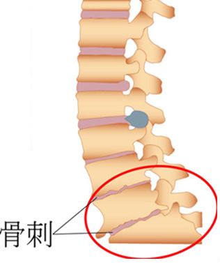 骨质增生